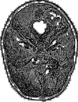 The skull, from Harlow's 1868 paper